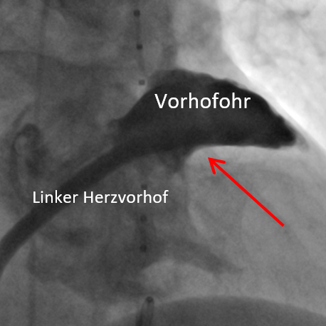 vorhofohr_bild-1a-kardiologie-angiologie-waldkrankenhaus-erlangen